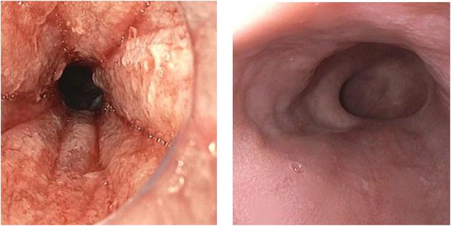 Figure 15.3, Left : Endoscopic appearance of Barrett’s esophagus (BE) immediately after radiofrequency ablation. Right : Complete eradication of intestinal metaplasia confirmed histologically 2 months after ablation. There is no visible BE and random biopsies showed no metaplasia.