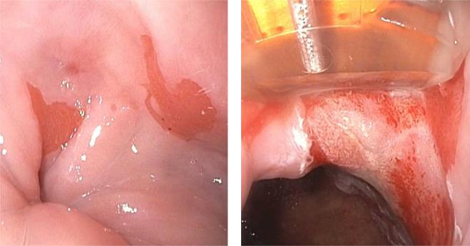 Figure 15.4, Left : Islands of endoscopically visible Barrett’s esophagus (BE) seen 2 months after radiofrequency ablation of long segment BE. Histology showed residual metaplasia. Right : Radiofrequency ablation of these islands of metaplasia.