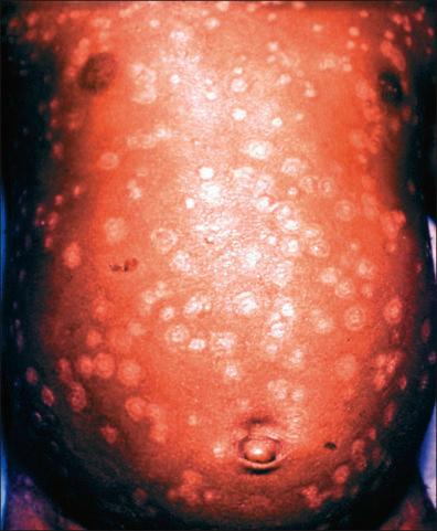 Figure 13-11, Smallpox: depigmented scars after loss of crusts.