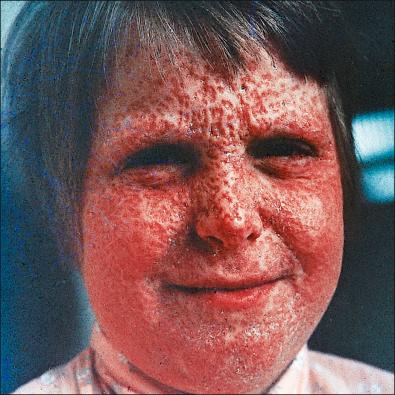 Figure 13-12, Smallpox: scarring after convalescence.