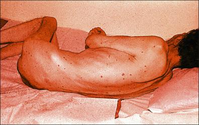 Figure 13-13, Complicated smallpox: flat hyporeactive smallpox in a 70-year-old man.