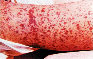 Figure 13-15, Complicated smallpox: early hemorrhagic smallpox.