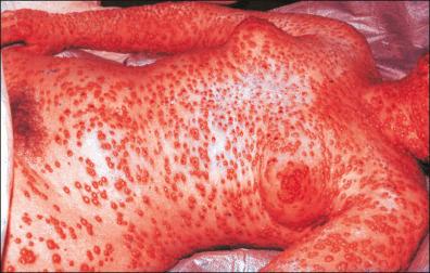 Figure 13-17, Complicated smallpox: late hemorrhagic smallpox, bleeding into preexisting smallpox.