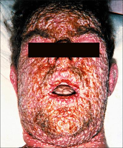 Figure 13-18, Complicated smallpox: massive excretion of poxviruses.