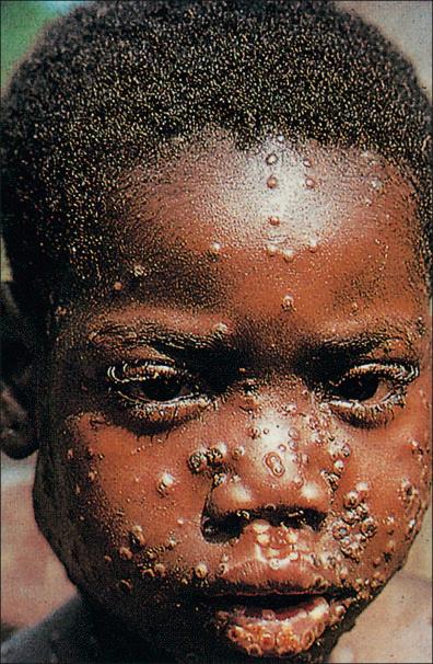 Figure 13-3, Monkeypox is a zoonotic infection, caused by an orthopoxvirus morphologically indistinguishable from that of smallpox; it produces a relatively benign infection in humans in parts of the tropical rain forest areas of West and Central Africa. This girl from Zaire showed large numbers of papules and pustules on the trunk, head, extremities, and external genitalia. Infection is acquired by handling or eating infected monkeys.