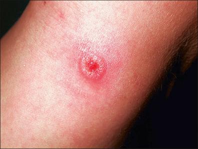Figure 13-4, Nodule of tanapox surrounded by a red halo on the arm of a student after contact with chimpanzees near the Tana river.