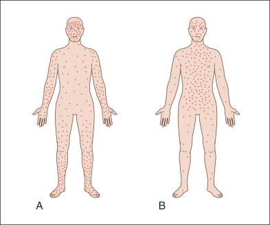 Figure 13-5, Distributions of eruptions in ( A ) smallpox and ( B ) chickenpox.