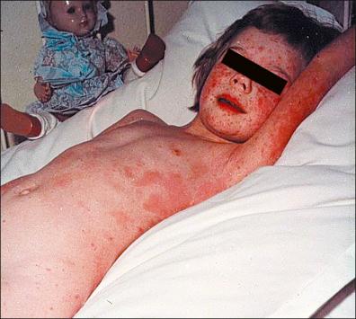 Figure 13-6, Smallpox: initial rash.