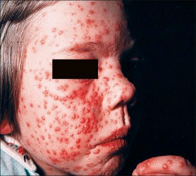 Figure 13-7, Smallpox: day 3 (vesicles).