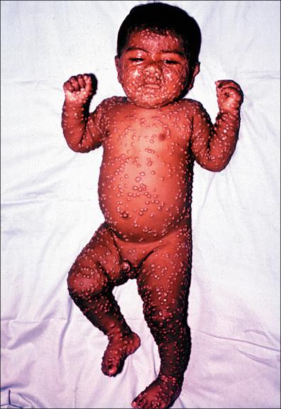 Figure 13-8, Smallpox: uniform vesicular eruption; distribution: eruption more concentrated on the face and extremities as compared with the trunk.