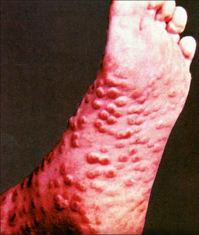 Figure 13-9, Smallpox: vesicular umbilicated lesions on the sole.