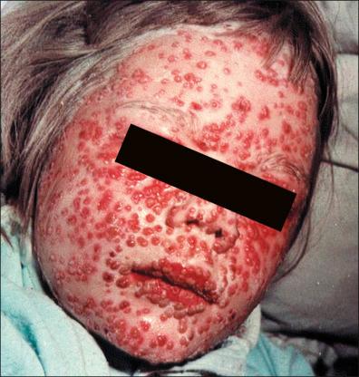 Figure 13-10, Smallpox: day 5; uniform pustular eruption.