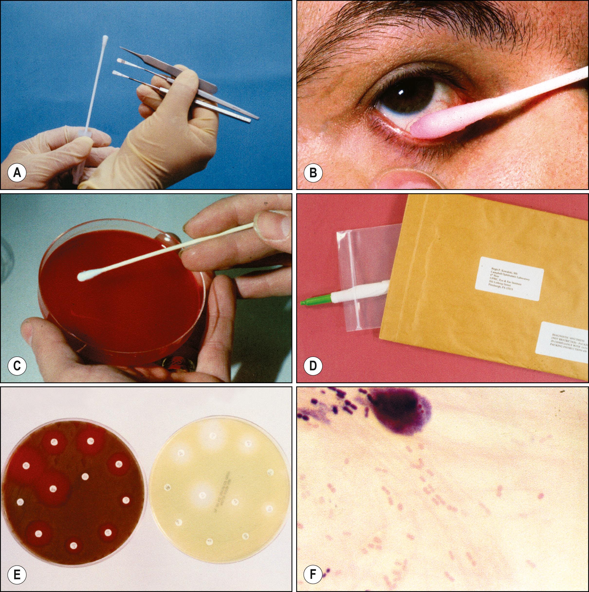 Fig. 9.1, Corneal specimen collection.