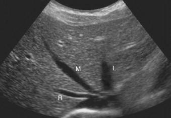 F igure 1-1, Interactions of sound with anatomic structures. Transverse view of the liver demonstrates the right (R), middle (M), and left (L) hepatic veins. They appear anechoic (black) because the intraluminal blood contains very weak reflectors. The walls of the hepatic veins are specular reflectors and their appearance will depend on their orientation to the sound beam. Because the right hepatic vein is oriented perpendicular to the direction of sound, its walls appear echogenic. The left and middle hepatic veins are not oriented perpendicular to the sound beam and so their walls are hypoechoic. The liver parenchyma appears intermediate in echogenicity because it contains multiple small-tissue interfaces that scatter the sound.