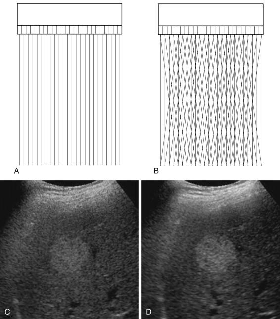 F igure 1-11, Real-time compounding. A, With conventional array function the scan lines are directed perpendicular to the surface of the transducer without any steering. B, Real-time compounding is produced by creating frames with different beam steering angles and averaging the frames together. C, Conventional image of the liver demonstrates a hemangioma with poorly defined margins. D, Similar image obtained with real-time compounding demonstrates better demarcation of the hemangioma from the adjacent liver parenchyma.