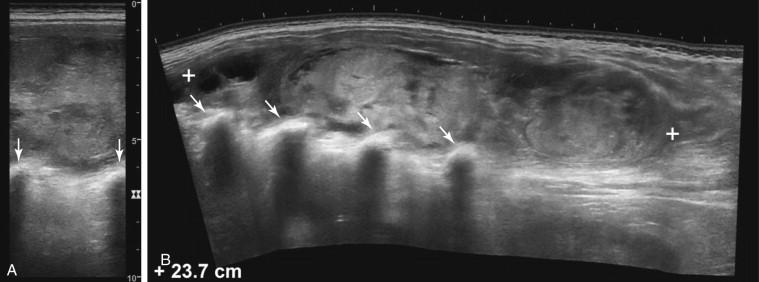 F igure 1-12, Panoramic, extended field of view imaging. A, Longitudinal view of the paraspinal musculature in the conventional real-time mode shows an acute hematoma that is too large to be visualized. It is also not possible to measure the length of the lesion or appreciate its relationship to the ribs (arrows). B, Panoramic view shows the entire extent of the hematoma, allowing for both measurement (cursors) and localization with respect to the ribs (arrows) .