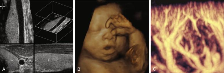 F igure 1-14, Three-dimensional imaging. A, Multiplanar reformatting of the thyroid and carotid in the sagittal and coronal plane obtained from source images in the axial plane. B, Surface rendering of a fetal face. C, Magnified three-dimensional volume-rendered image of renal cortical blood flow obtained with power Doppler imaging.