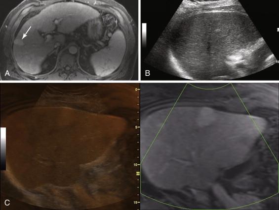 e -F igure 1-1, Fusion imaging. A, Contrast-enhanced magnetic resonance imaging (MRI) shows an enhancing mass in the right hemiliver (arrow). B, Sonogram of the same area shows no visible mass, precluding accurate biopsy. C, Fusion of the MRI data set with the ultrasound image allows for localization of the otherwise invisible mass on the fused image (left) and correlation with the MRI scan (right).