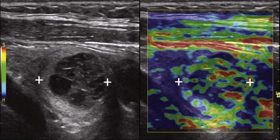 F igure 1-15, Elastography scan of a benign thyroid nodule (cursors) shows dual images, with a gray-scale view on the left and an elastogram on the right. The elastogram shows reds, yellows, and greens, indicating that this is a relatively soft nodule.