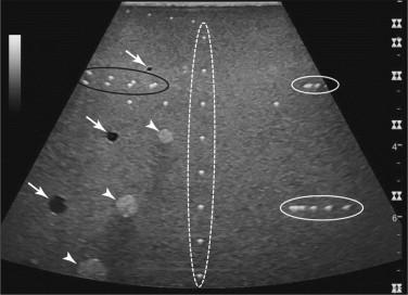 F igure 1-4, View of an ultrasound phantom shows multiple echogenic pins viewed in cross section. The pins in the dashed white oval are used to test linear measurement accuracy. The pins in the solid white ovals are used to test lateral resolution. The pins in the black oval are used to test axial resolution. Variably sized cylinders filled with fluid (arrows) and solid material (arrowheads) are used to test contrast resolution.