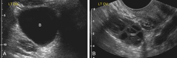 F igure 1-9, Endoluminal probe. A, Transabdominal view using a 3.5-MHz transducer demonstrates the left ovary (cursors) posterior to the urinary bladder (B). Ovarian follicles are difficult to see well. B, Transvaginal view with a 5.5-MHz transducer demonstrates the left ovary (cursors). Ovarian follicles are seen much more clearly than on the transabdominal view. The ovary appears much larger because the field of view for transvaginal scanning is much smaller than for transabdominal scanning. LT OV, Left ovary.