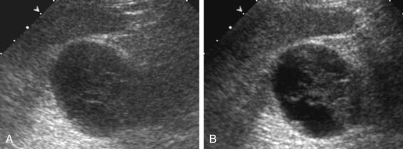 F igure 1-10, Tissue harmonic imaging. A, Conventional fundamental frequency scan of a renal cyst demonstrates amorphous internal echoes. B, Harmonic imaging demonstrates well-defined solid material within this renal cyst secondary to internal hemorrhage.