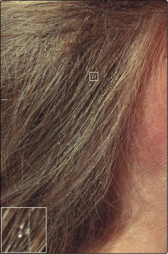 Fig. 10.1, Head lice and nits are evident on a hair shaft.