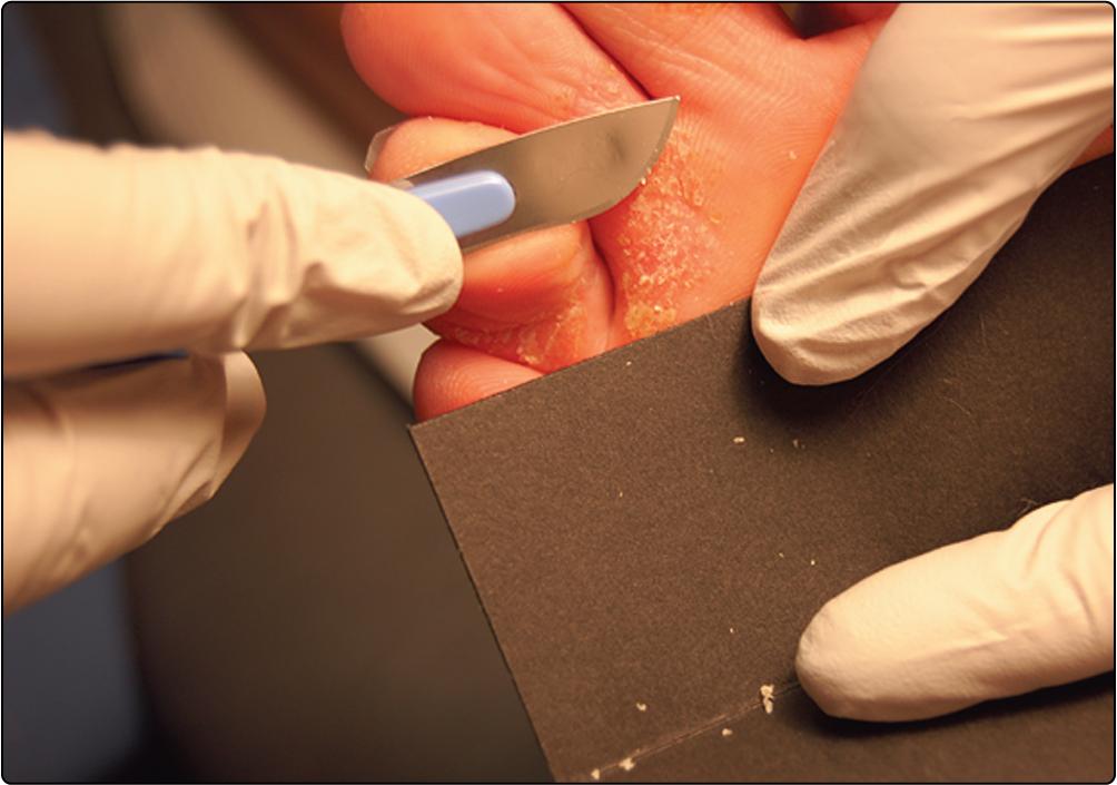 Fig. 10.2, Take a scraping from the edge of an area of suspected fungal infection by using a disposable scalpel blade.