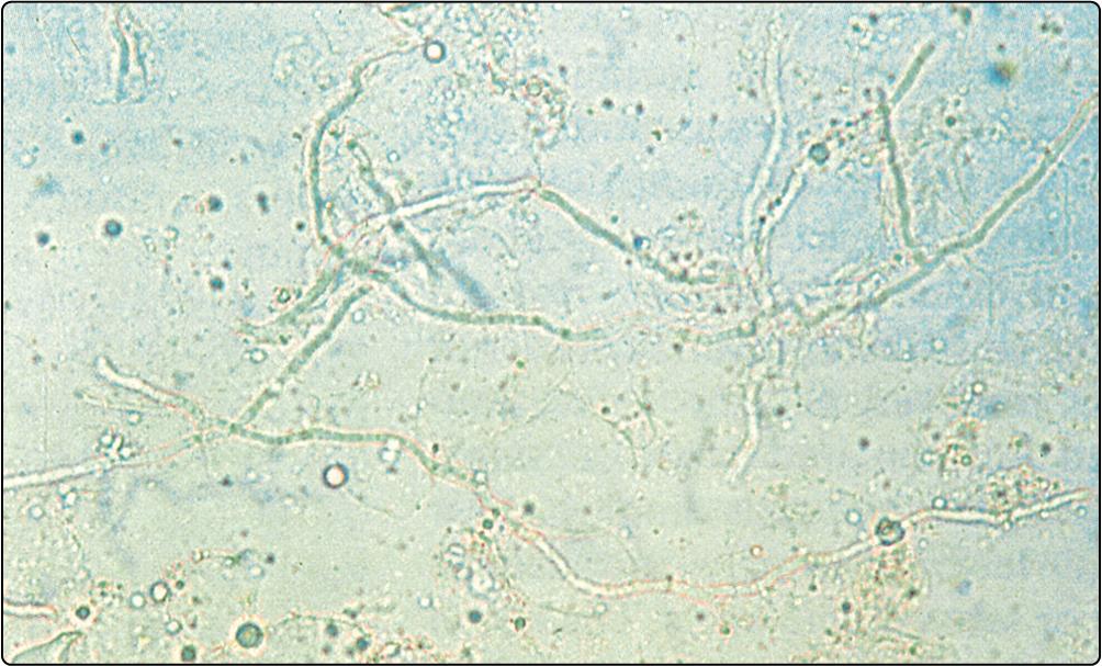 Fig. 10.3, Microscopy of skin scrapings showing fungal hyphae.