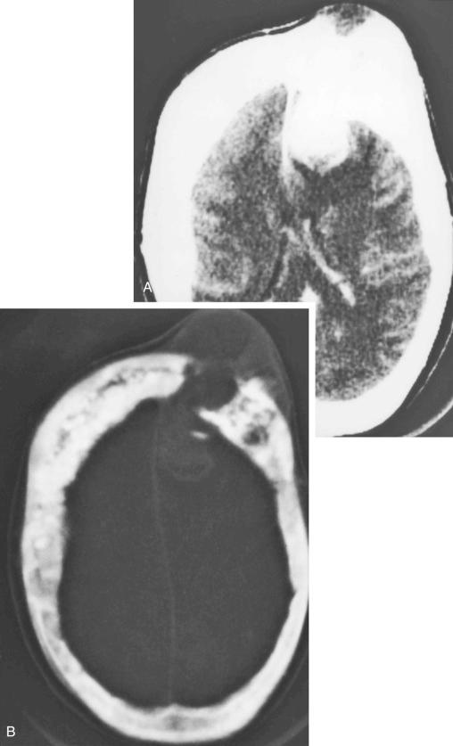 FIGURE 24-13, Paget's sarcoma of skull: radiographic features.