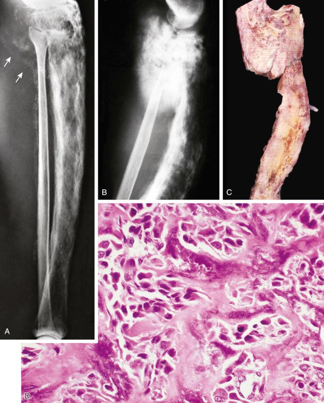 FIGURE 24-14, Paget's sarcoma: radiographic, gross, and microscopic features.