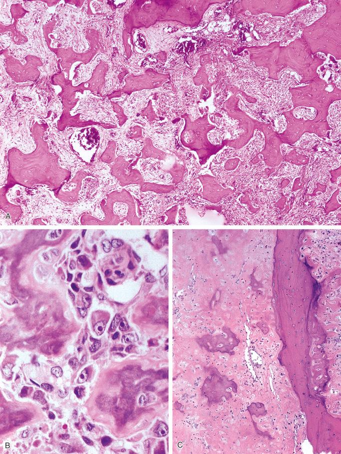 FIGURE 24-15, Paget's disease with secondary osteosarcoma.