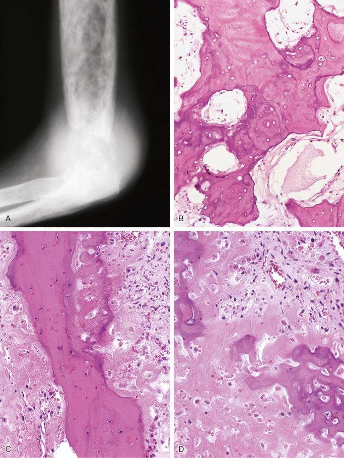 FIGURE 24-16, Paget's disease with secondary osteosarcoma.