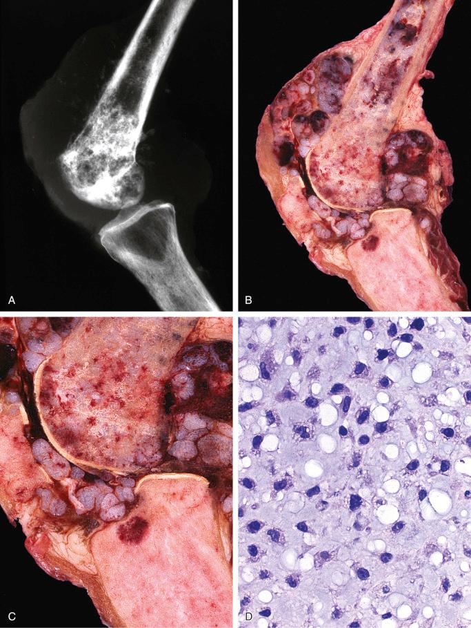 FIGURE 24-17, Chondrosarcoma, grade ii secondary to Paget's disease of femur.