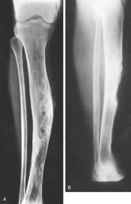 FIGURE 24-18, Chronic osteomyelitis: radiographic features.