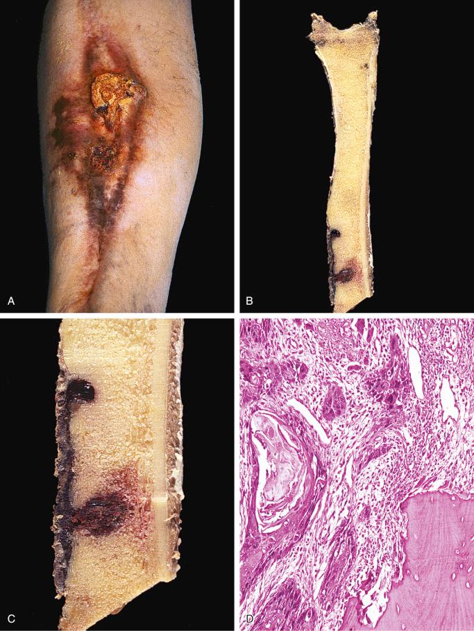 FIGURE 24-19, Squamous cell carcinoma associated with chronic osteomyelitis.