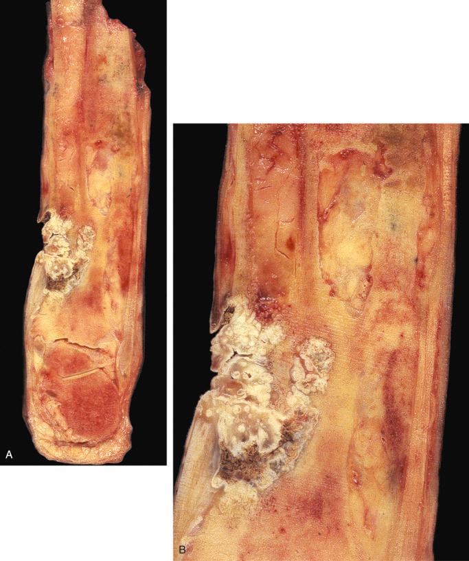 FIGURE 24-20, Squamous cell carcinoma in association with chronic osteomyelitis.