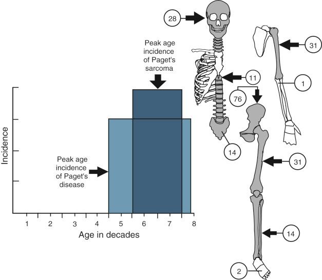 FIGURE 24-2, Paget's disease and sarcomatoid transformation.