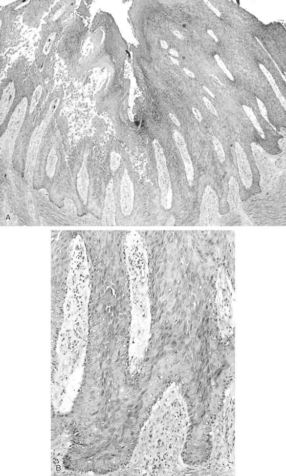 FIGURE 24-21, Chronic osteomyelitis: microscopic features of pseudoepitheliomatous hyperplasia.