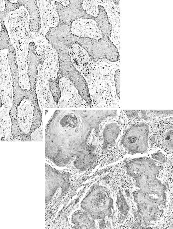 FIGURE 24-22, Pseudoepitheliomatous hyperplasia versus well-differentiated squamous cell carcinoma: microscopic features.