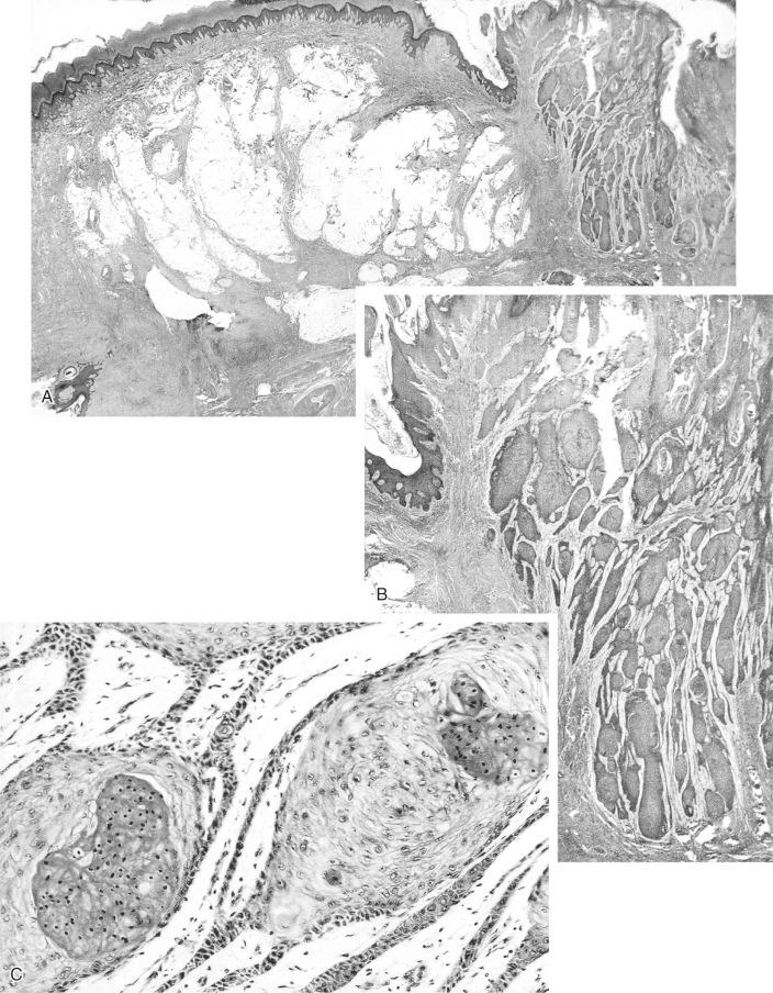 FIGURE 24-23, Squamous cell carcinoma developing within fistulous tract of chronic osteomyelitis.