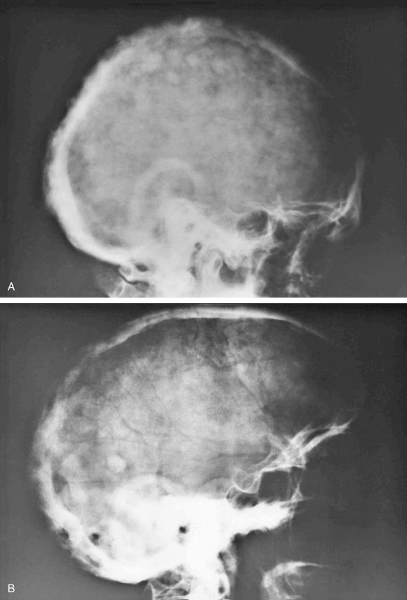 FIGURE 24-3, Paget's disease of skull: radiographic features.