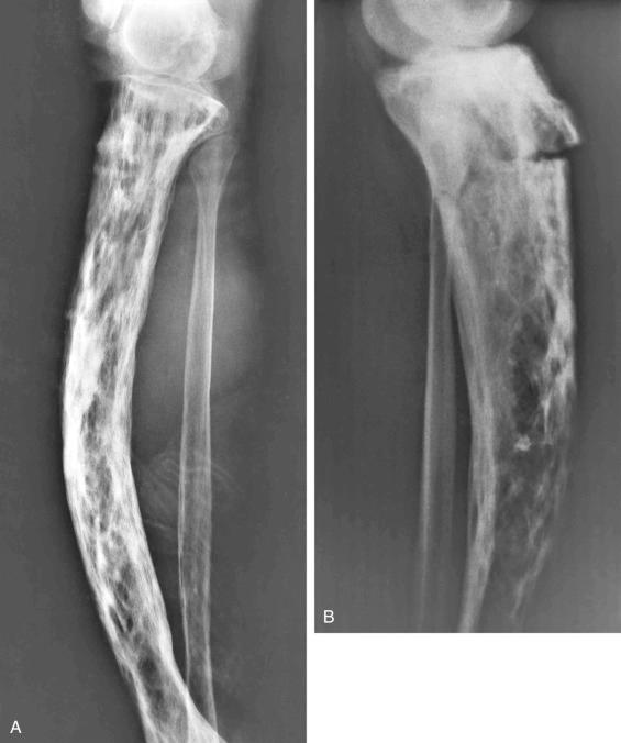 FIGURE 24-4, Paget's disease of bone: radiographic features.