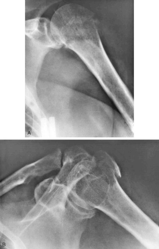 FIGURE 24-5, Paget's disease of humerus: radiographic features.