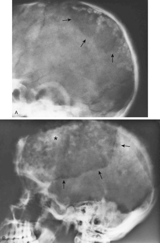 FIGURE 24-6, Paget's disease of skull: radiographic features.