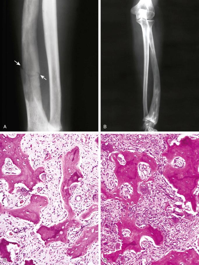 FIGURE 24-7, Paget's disease of long bones: radiographic features.