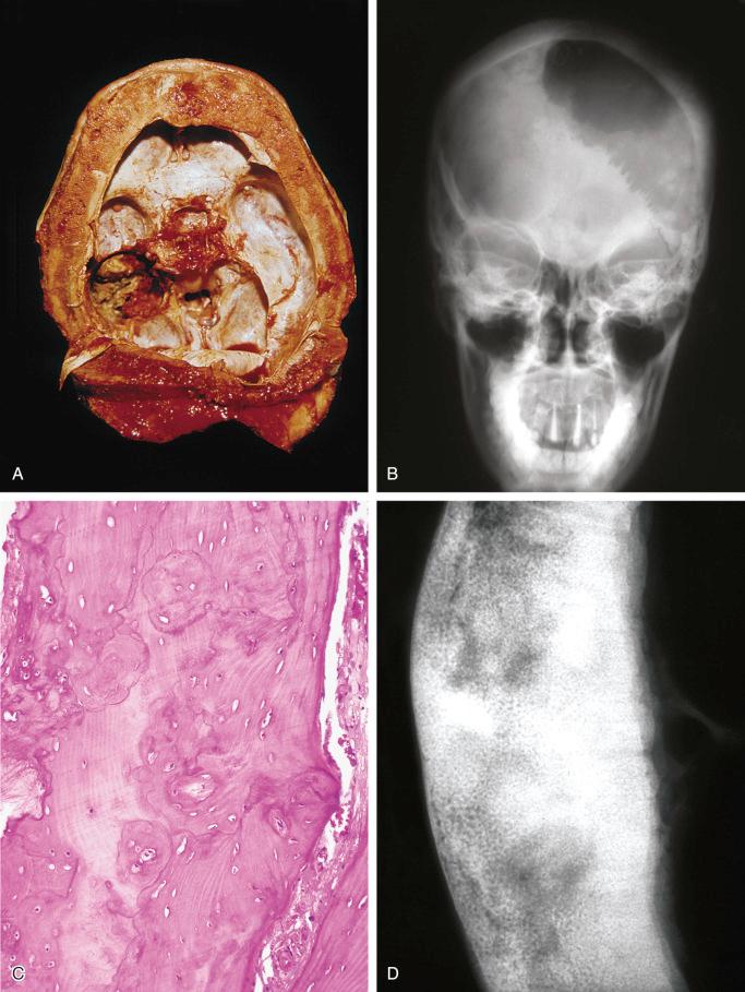 FIGURE 24-8, Paget's disease: gross, radiographic, and microscopic features.