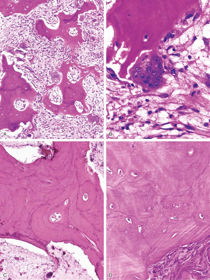 FIGURE 24-9, Paget's disease: microscopic features.