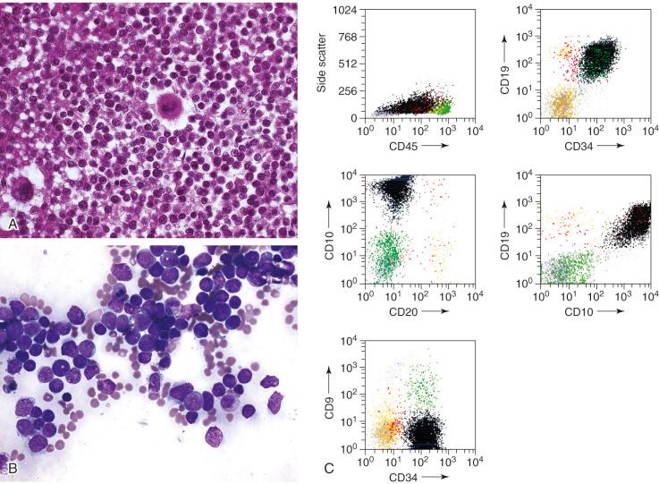 Figure 42-1, B-cell acute lymphoblastic leukemia (ALL).