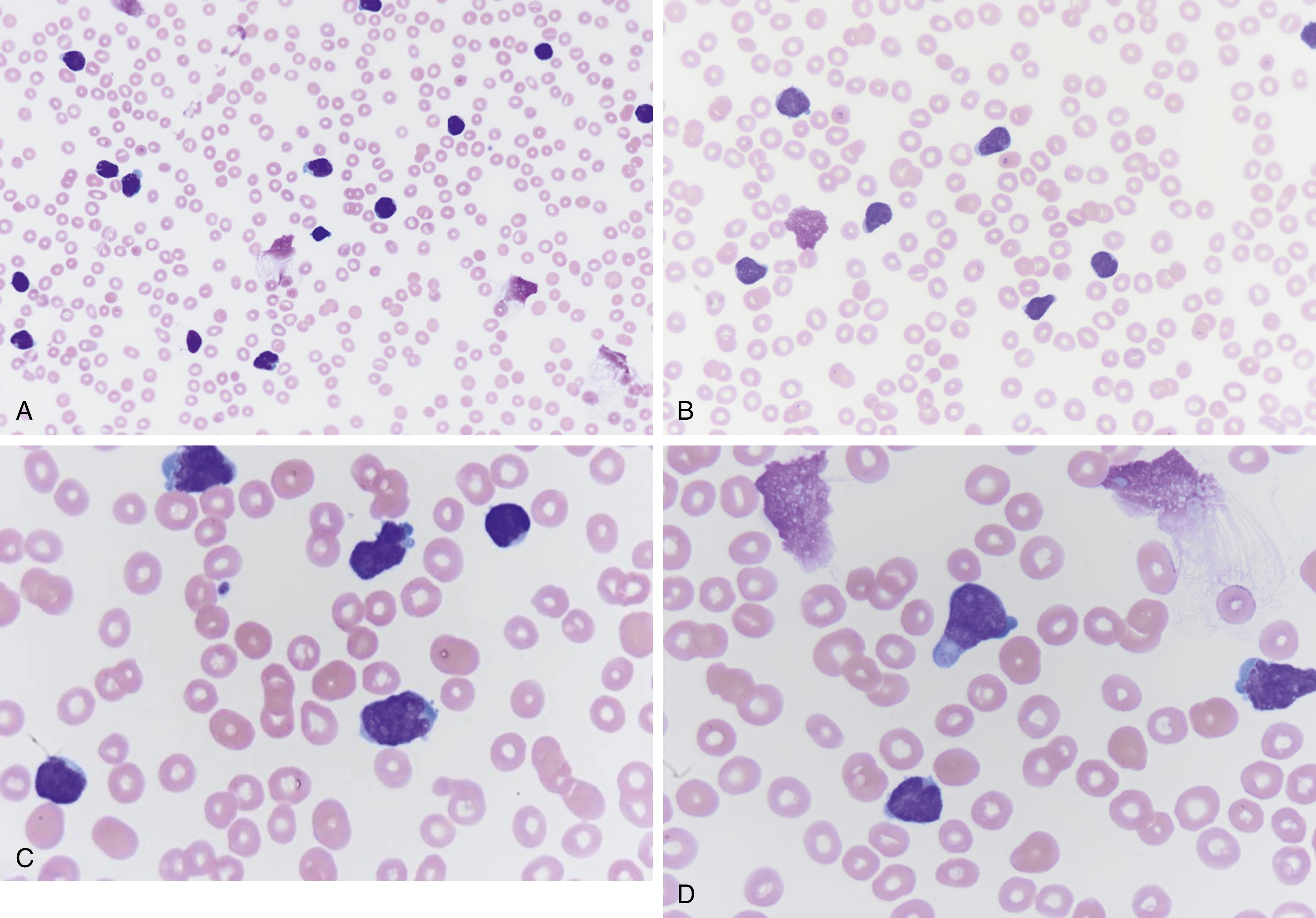 Fig. 9.4, (A) Peripheral blood smear showing increased atypical lymphoblast cells, many slightly larger than red blood cells, scant cytoplasm, few with podlike projections (magnification ×400). (B) Peripheral blood smear shows increased atypical lymphoblasts, podlike projections, scanty cytoplasm, indistinct nucleoli, fine velvet-like chromatin, and few nuclear clefts (magnification ×600). (C) Peripheral blood smear showing increased lymphoblasts, some with nuclear indentations, several nucleoli, scanty cytoplasm, slightly larger relative to red blood cells (magnification ×1000). (D) Peripheral blood smear showing increased lymphoblasts with podlike projections, indistinct nucleoli, scant cytoplasm, and fine chromatin (magnification ×1000).